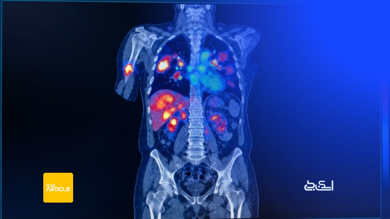 What does SUVmax mean in a PET scan1